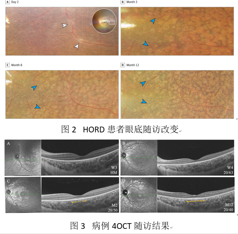 中山大学丁小燕团队发现一种新的眼底疾病——超急性视网膜外层功能障碍（HORD）