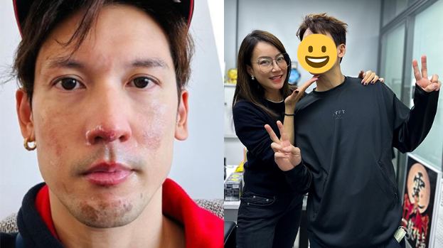 关智斌脸部烧伤后重返靓仔行列，霍汶希验证：皮肤好嫩滑